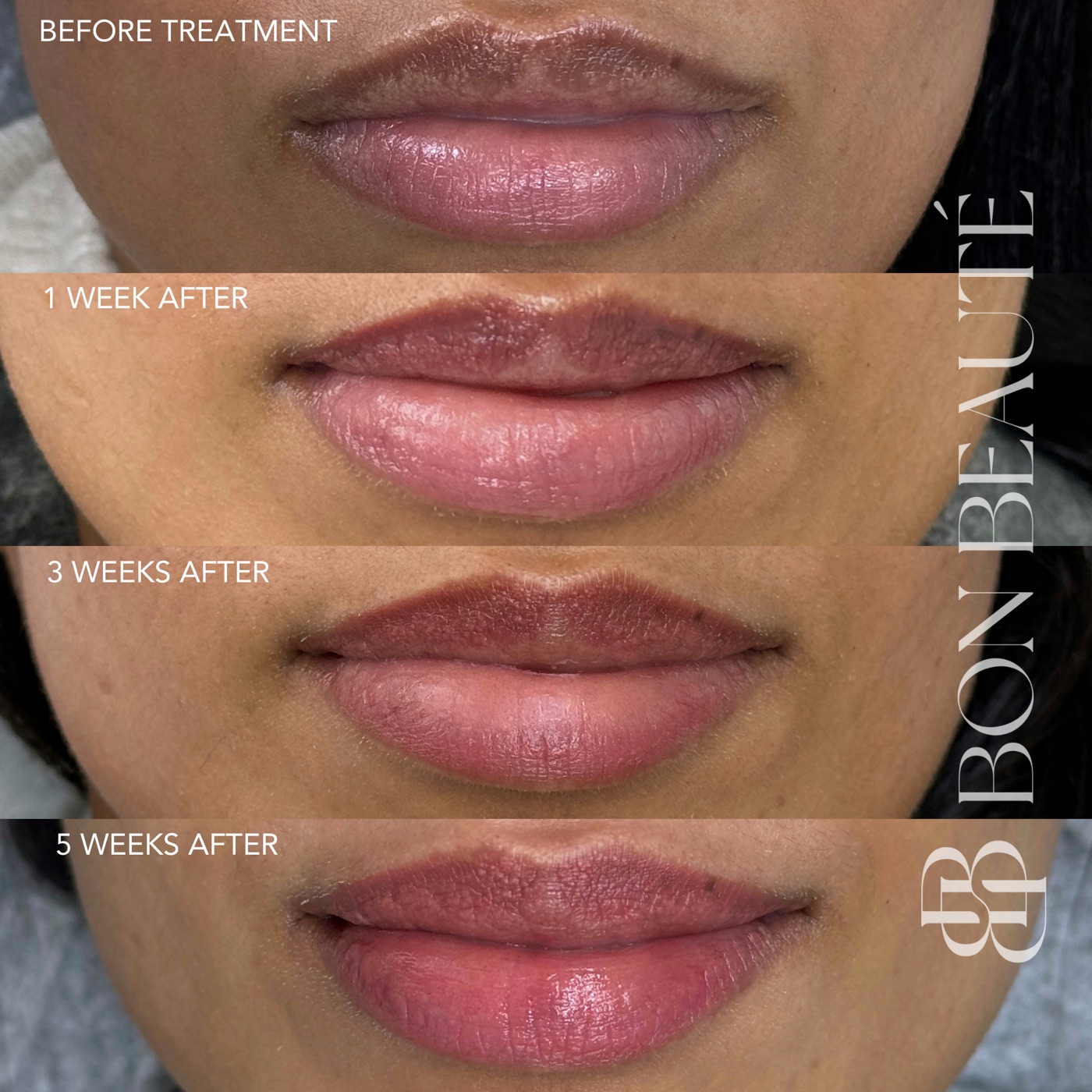 Lip blush healing across five weeks