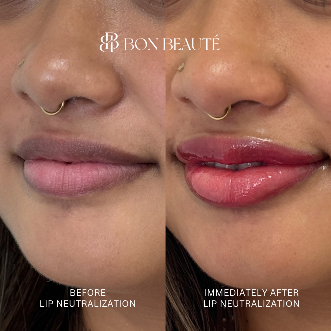 Lip neutralization before and after