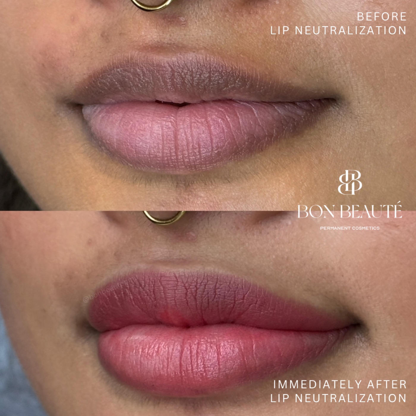 Lip neutralization before and after