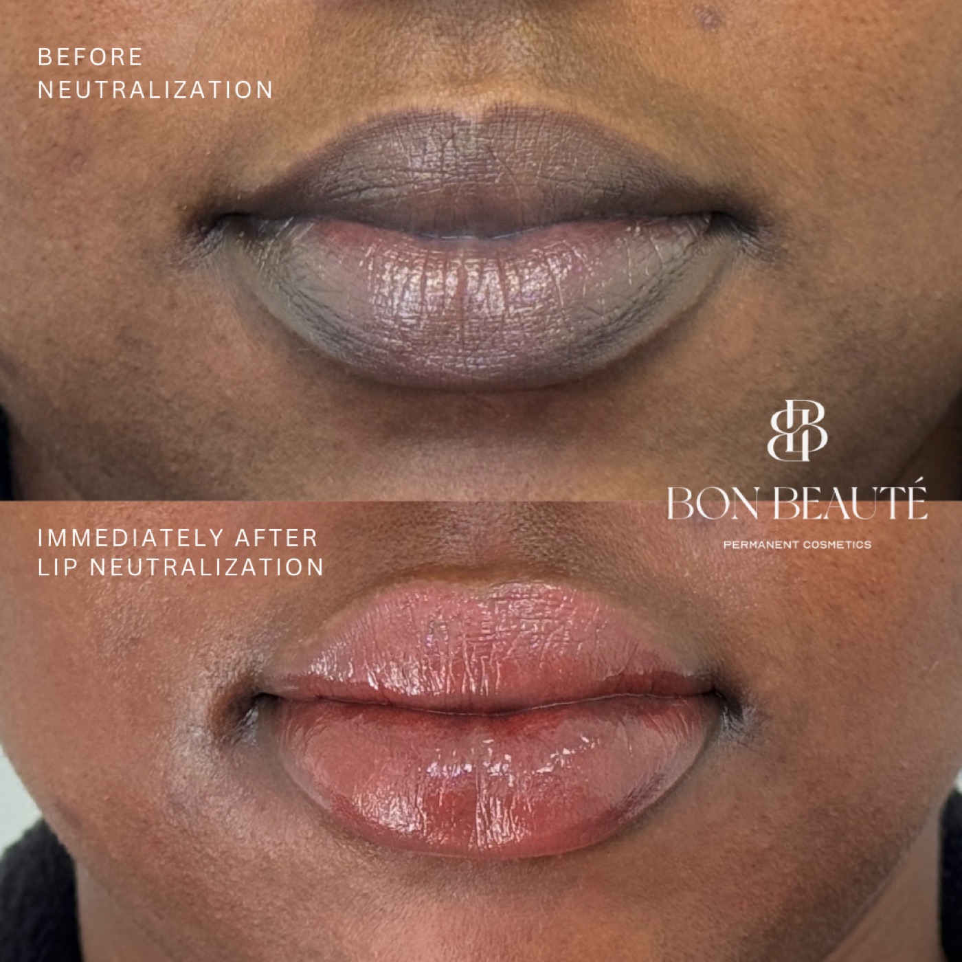 Lip neutralization before and after