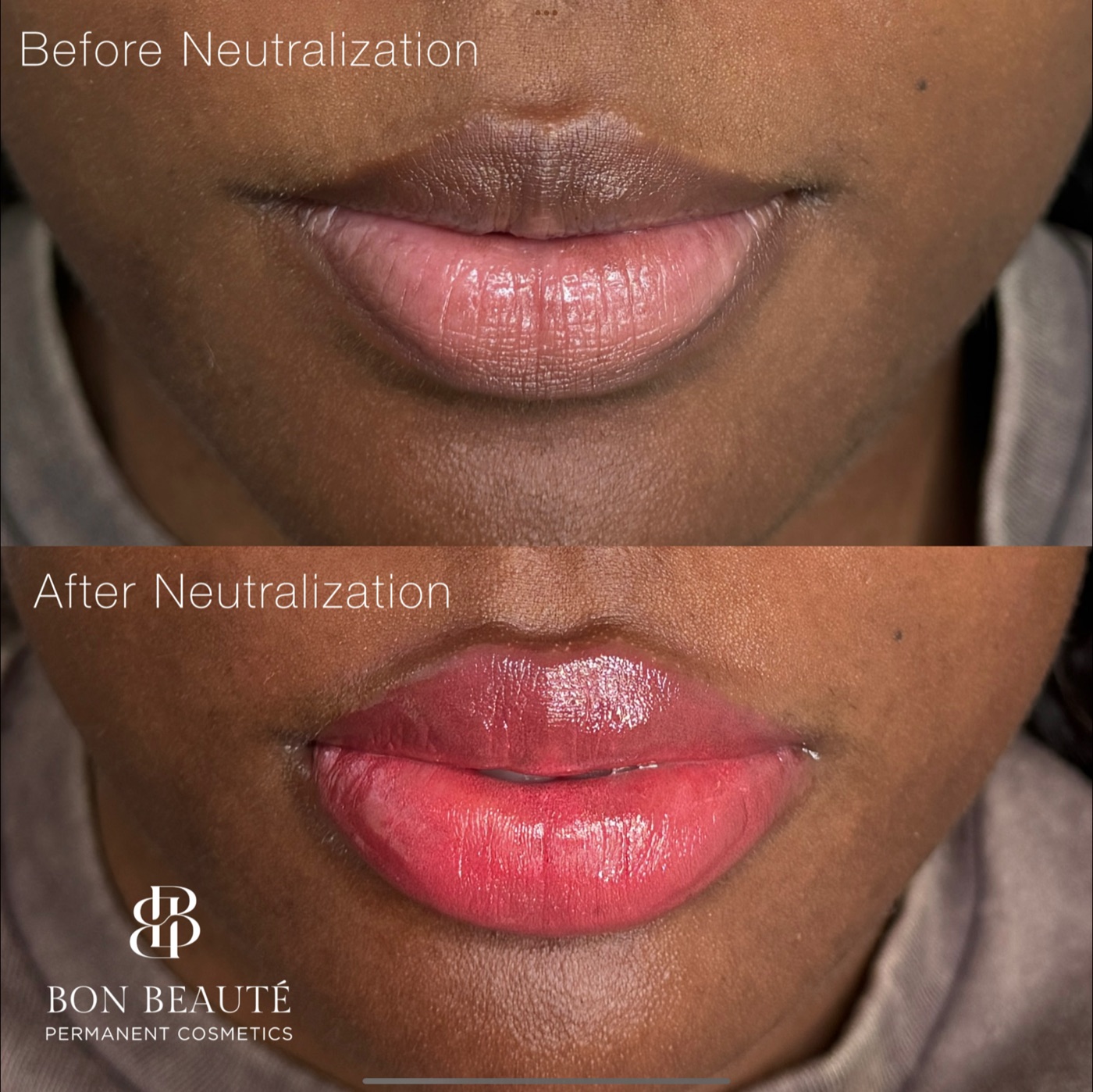 Lip neutralization before and after