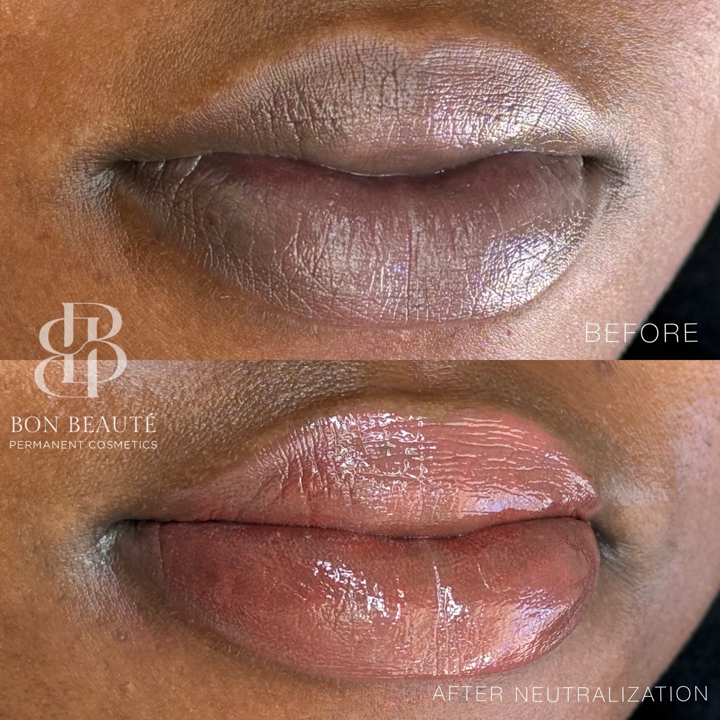 Lip neutralization before and after