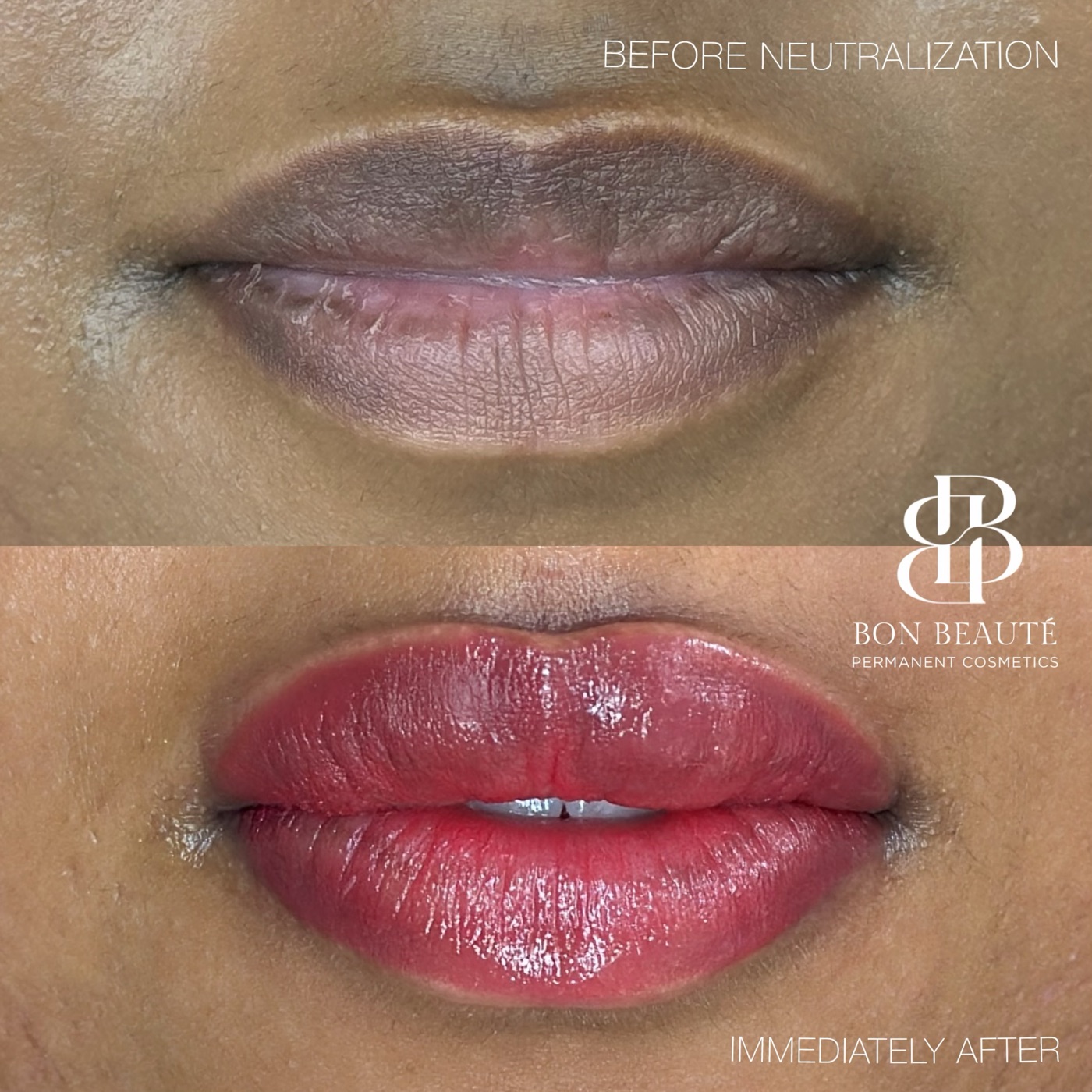 Lip neutralization before and after