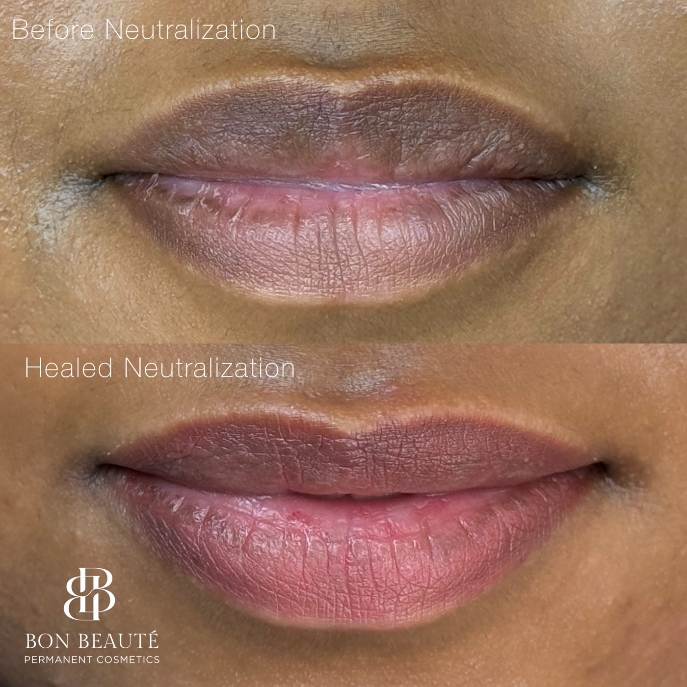 Lip neutralization before and healed