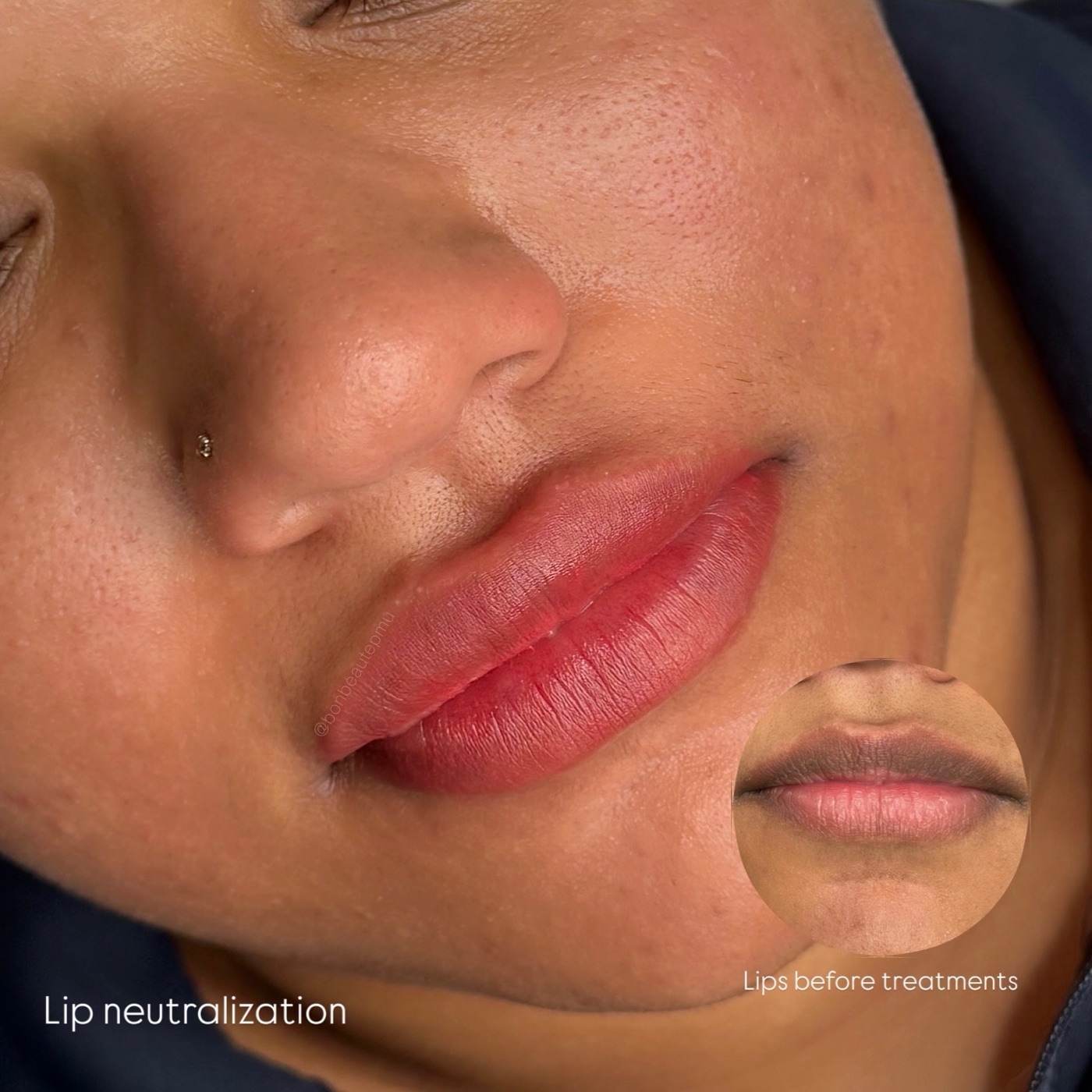 Lip neutralization result with before inset
